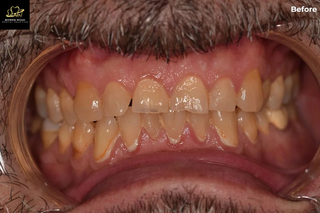 Tooth_wear_before