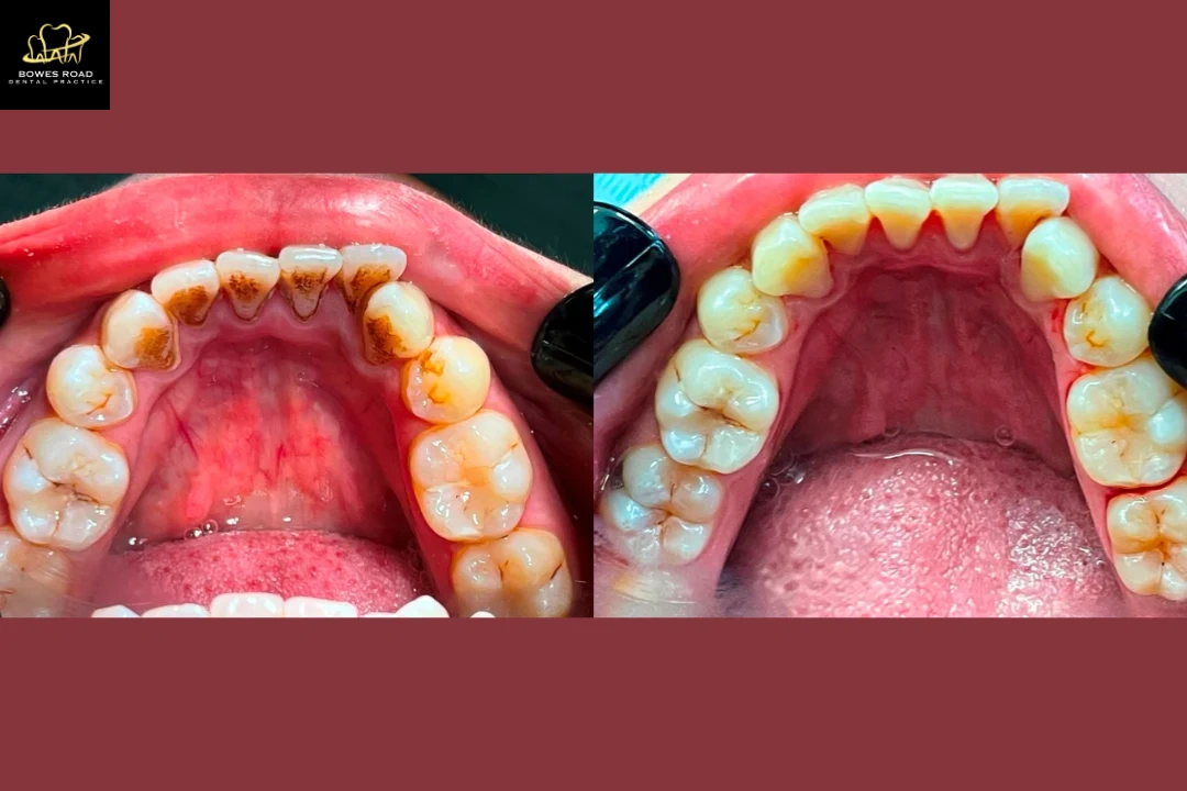 Hygien-before-and-after